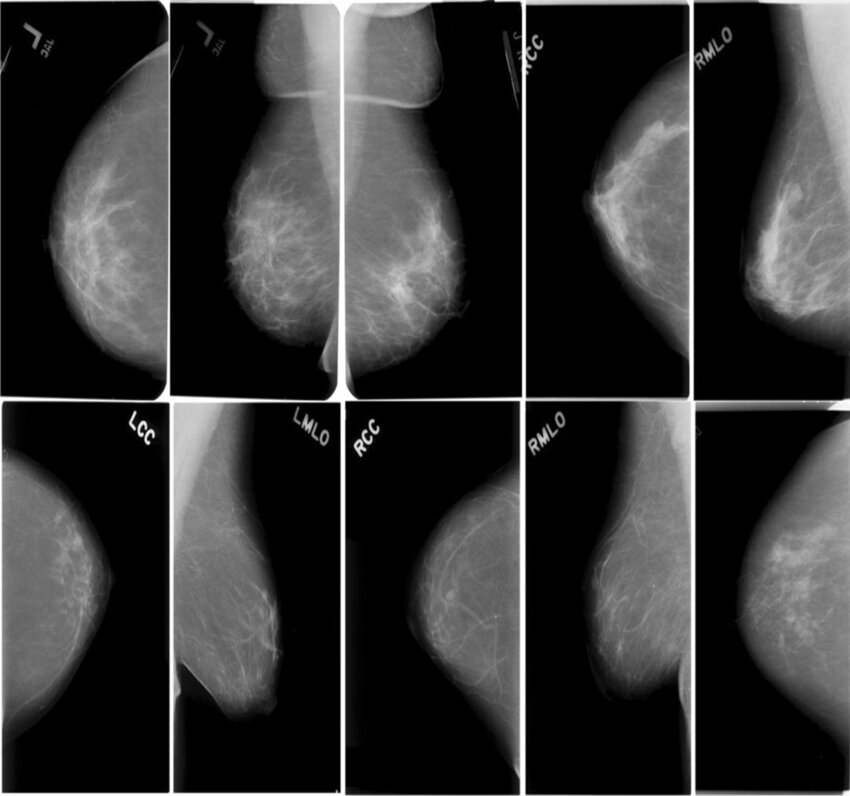 Breast Cancer Detection ML